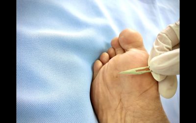 Do Genetics Play a Significant Role in the Formation of Bunions
