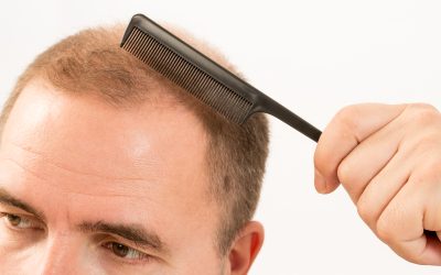 Non-Surgical Hair Restoration Treatments at Creekside